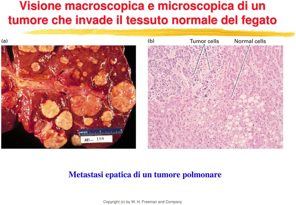 invade il tessuto normale del