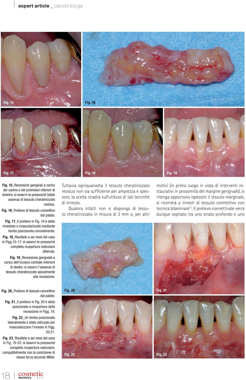 17_Il prelievo in Fig. 16 è stato innestato e rivascolarizzato mediante lembo posizionato coronalmente. Fig. 18_Risultato a sei mesi del caso in Figg.