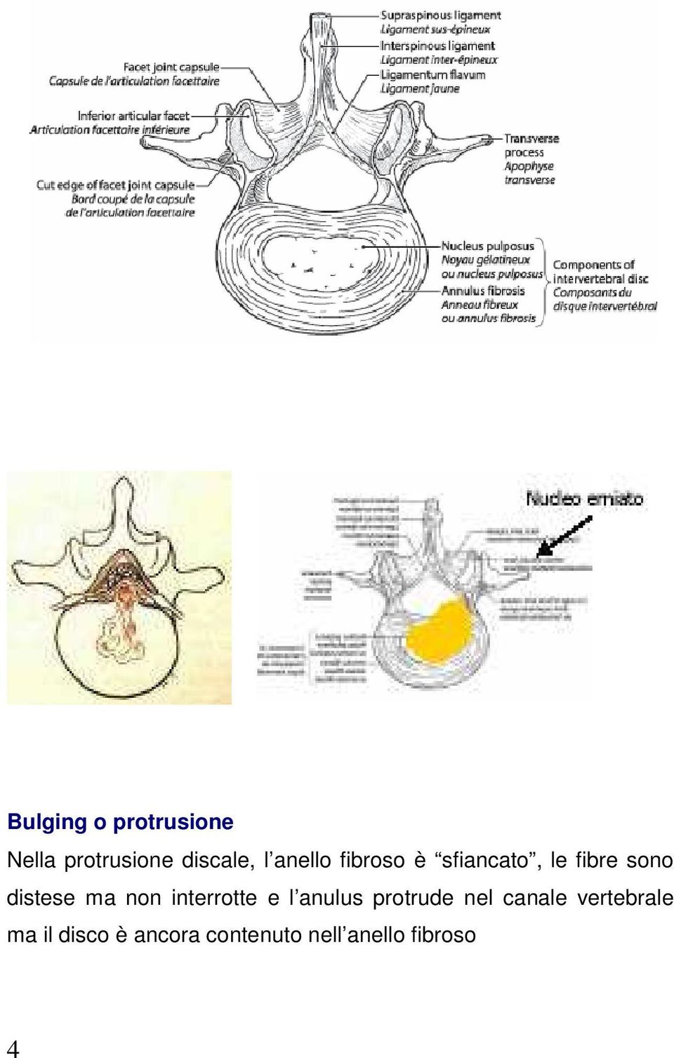 non interrotte e l anulus protrude nel canale