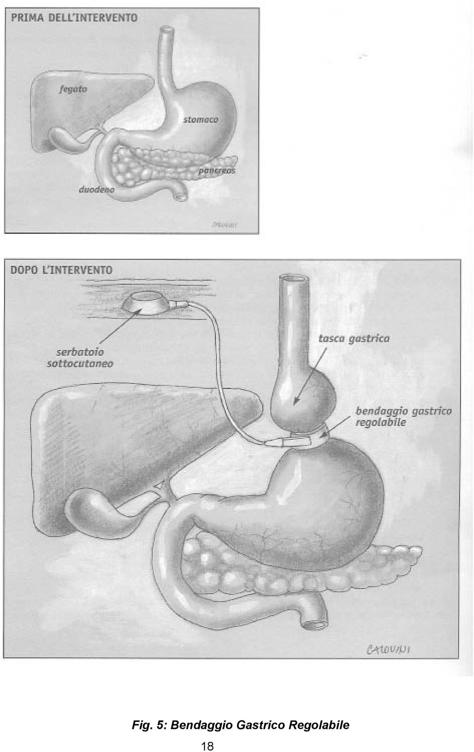 Gastrico