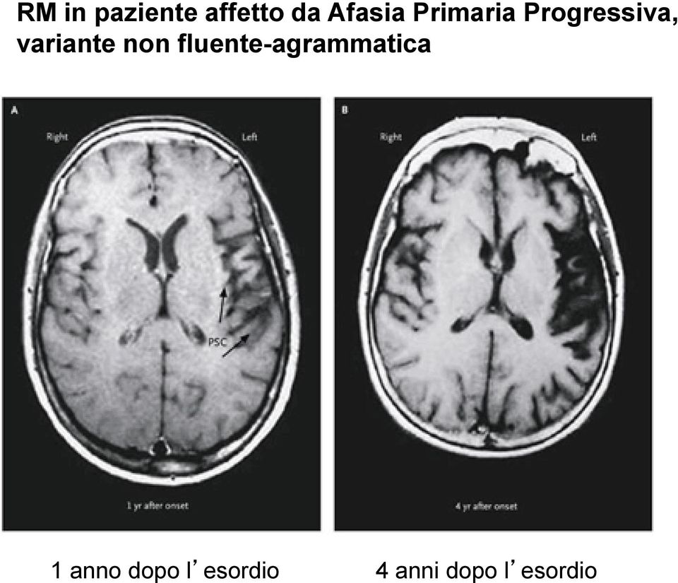 non fluente-agrammatica 1 anno