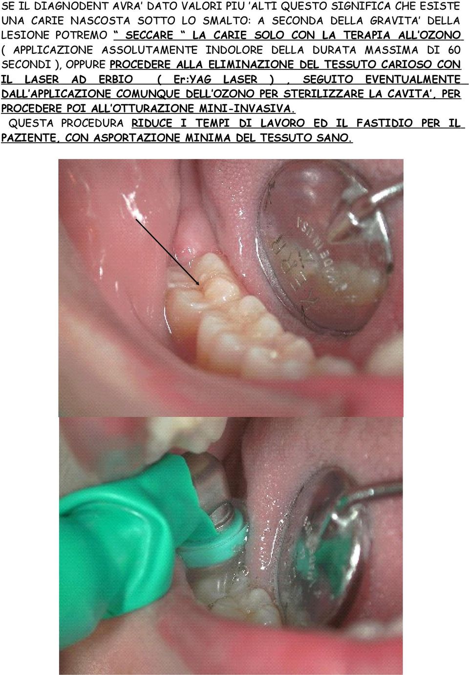 ELIMINAZIONE DEL TESSUTO CARIOSO CON IL LASER AD ERBIO ( Er:YAG LASER ), SEGUITO EVENTUALMENTE DALL APPLICAZIONE COMUNQUE DELL OZONO PER STERILIZZARE LA