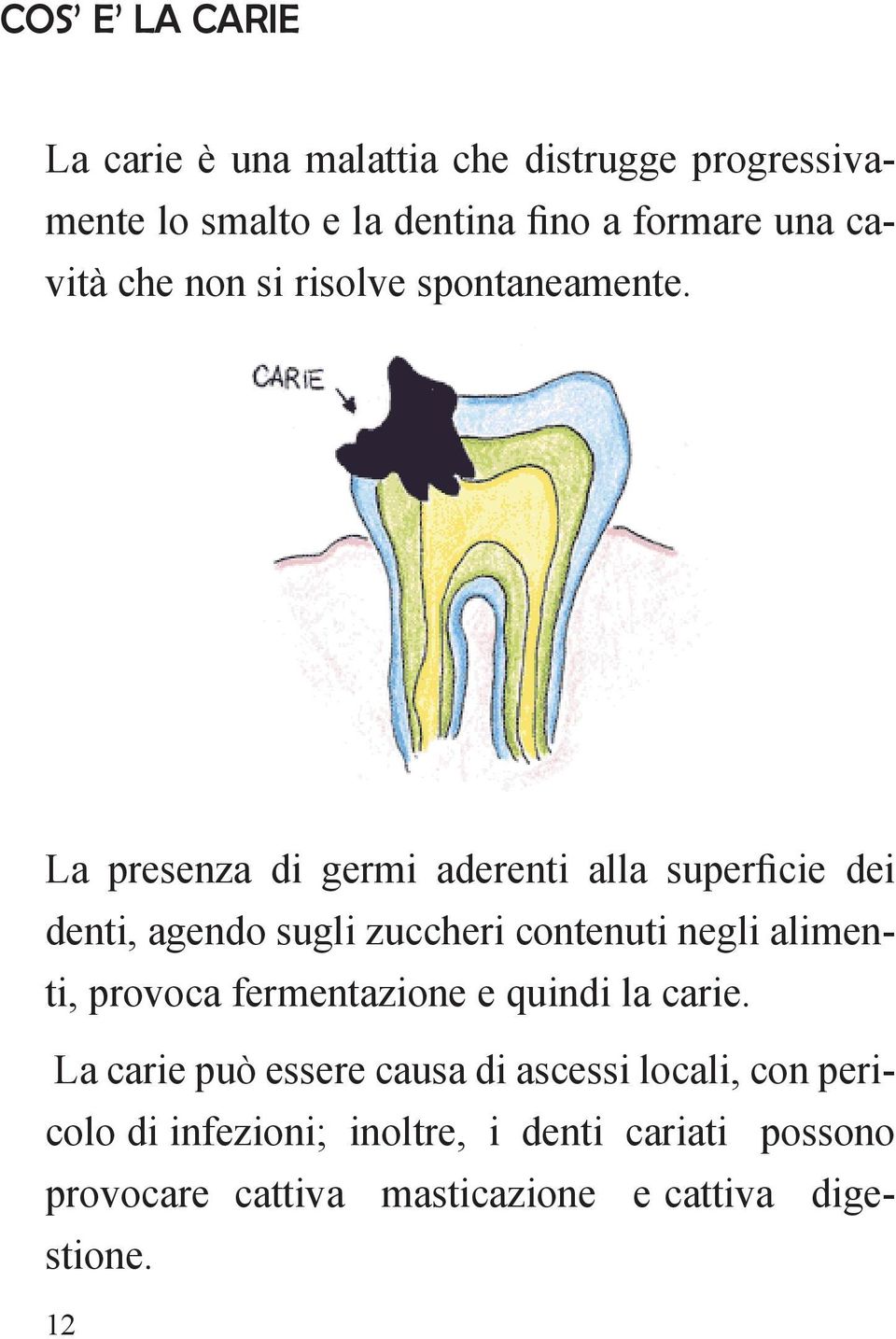 La presenza di germi aderenti alla superficie dei denti, agendo sugli zuccheri contenuti negli alimenti, provoca