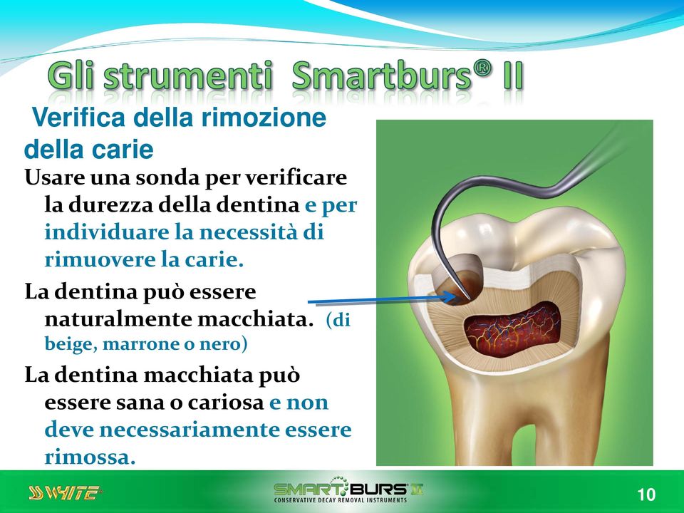 La dentina può essere naturalmente macchiata.