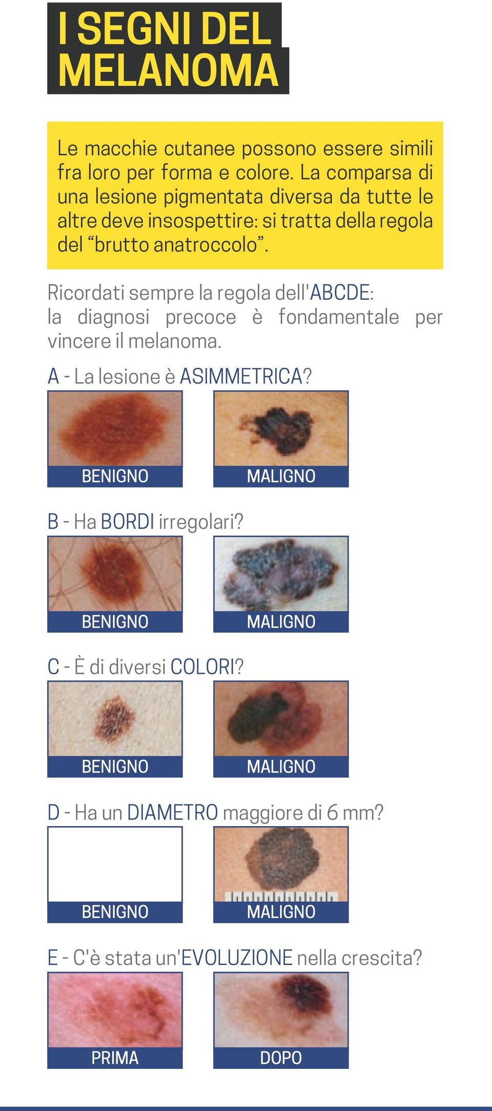 Ricordati sempre la regola dell'abcde: la diagnosi precoce è fondamentale per vincere il melanoma. A - La lesione è ASIMMETRICA?