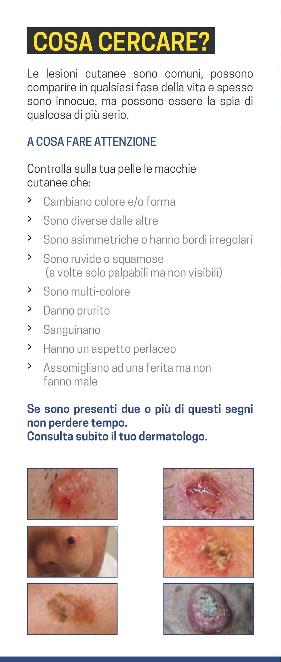 A COSA FARE ATTENZIONE Controlla sulla tua pelle le macchie cutanee che: Cambiano colore e/o forma Sono diverse dalle altre Sono asimmetriche o hanno