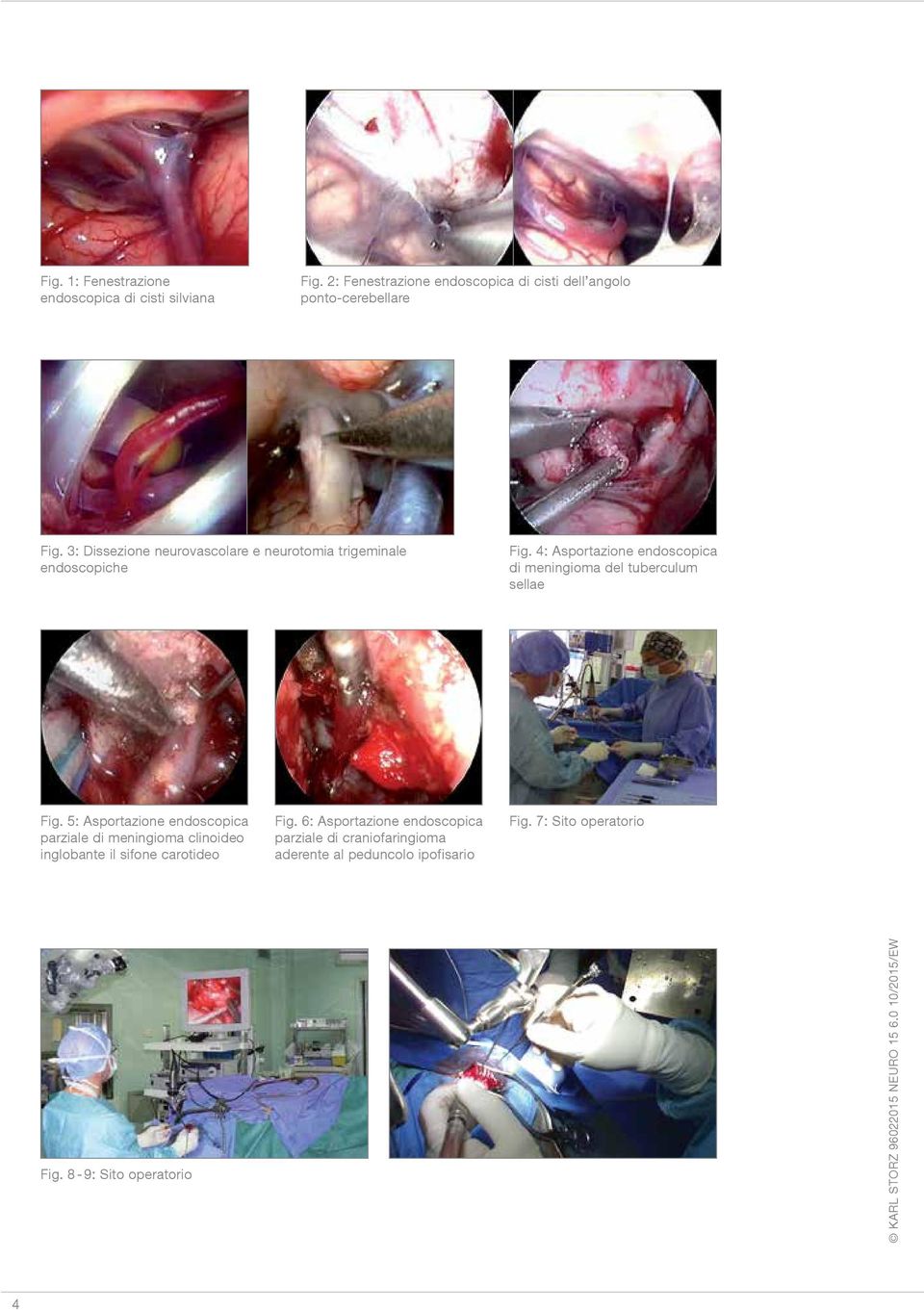 3: Dissezione neurovascolare e neurotomia trigeminale endoscopiche Fig.