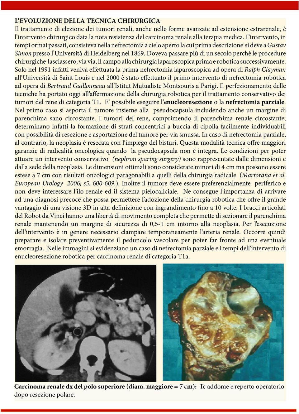 L intervento, in tempi ormai passati, consisteva nella nefrectomia a cielo aperto la cui prima descrizione si deve a Gustav Simon presso l Università di Heidelberg nel 1869.