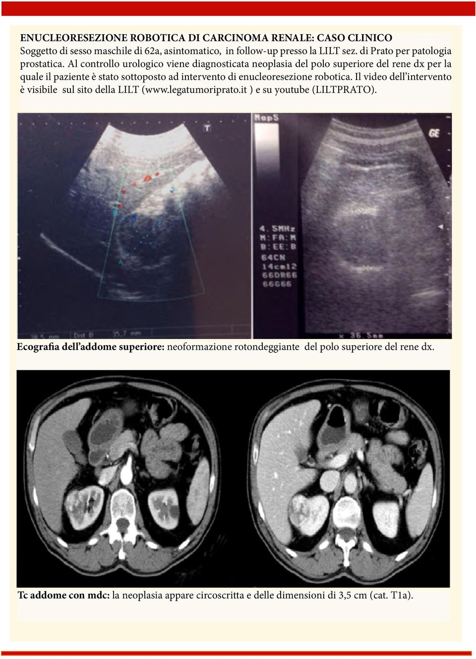 Al controllo urologico viene diagnosticata neoplasia del polo superiore del rene dx per la quale il paziente è stato sottoposto ad intervento di