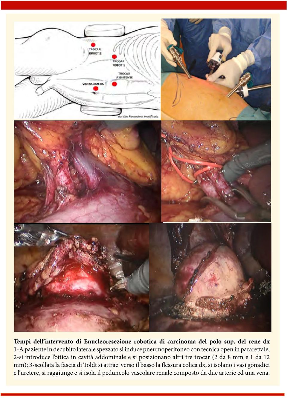 introduce l ottica in cavità addominale e si posizionano altri tre trocar (2 da 8 mm e 1 da 12 mm); 3-scollata la fascia di