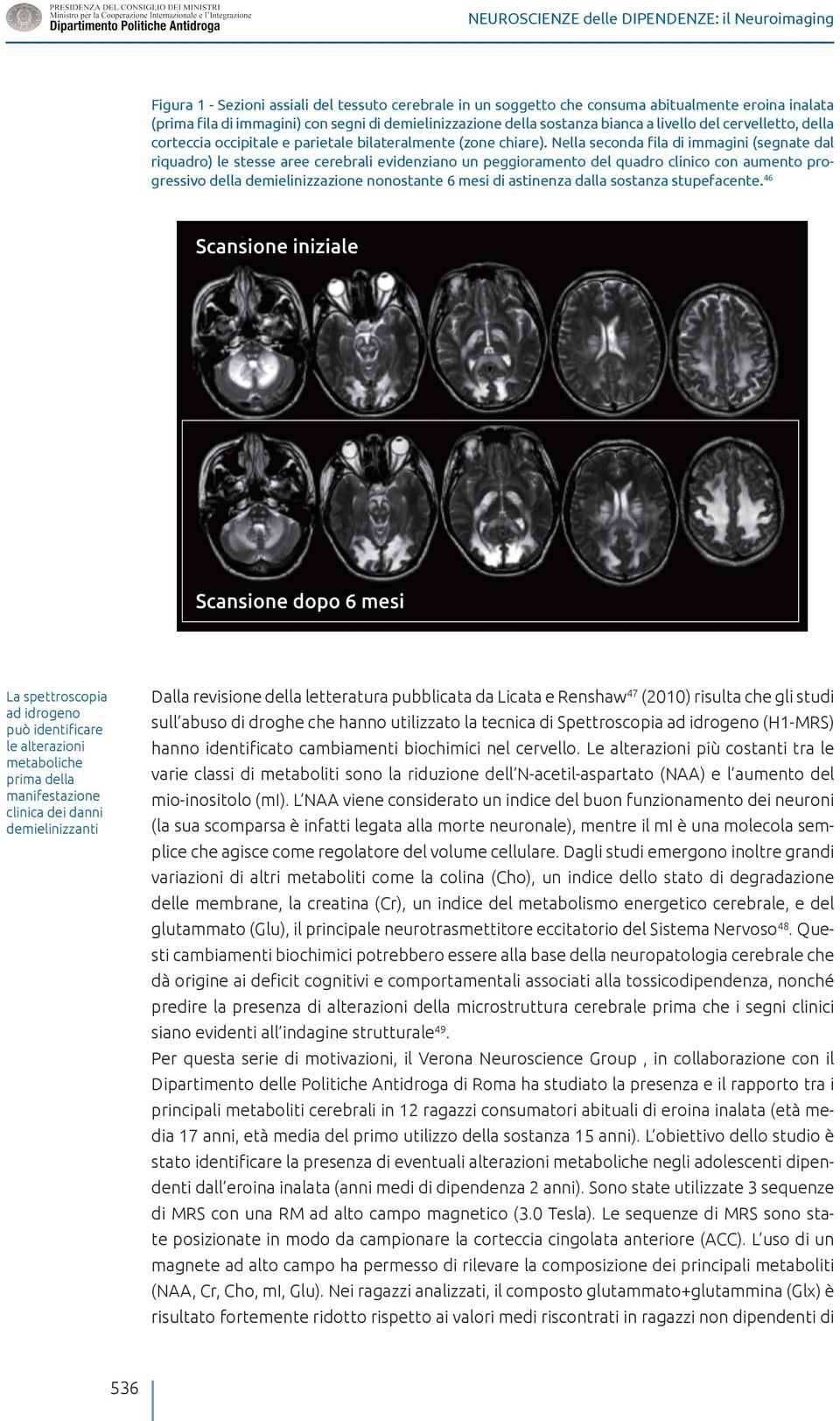 Nella seconda fila di immagini (segnate dal riquadro) le stesse aree cerebrali evidenziano un peggioramento del quadro clinico con aumento progressivo della demielinizzazione nonostante 6 mesi di