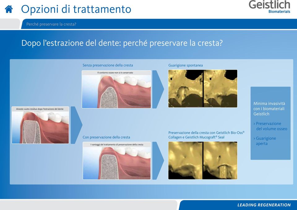 invasività con i biomateriali Geistlich Con preservazione della cresta I vantaggi del trattamento di preservazione della cresta