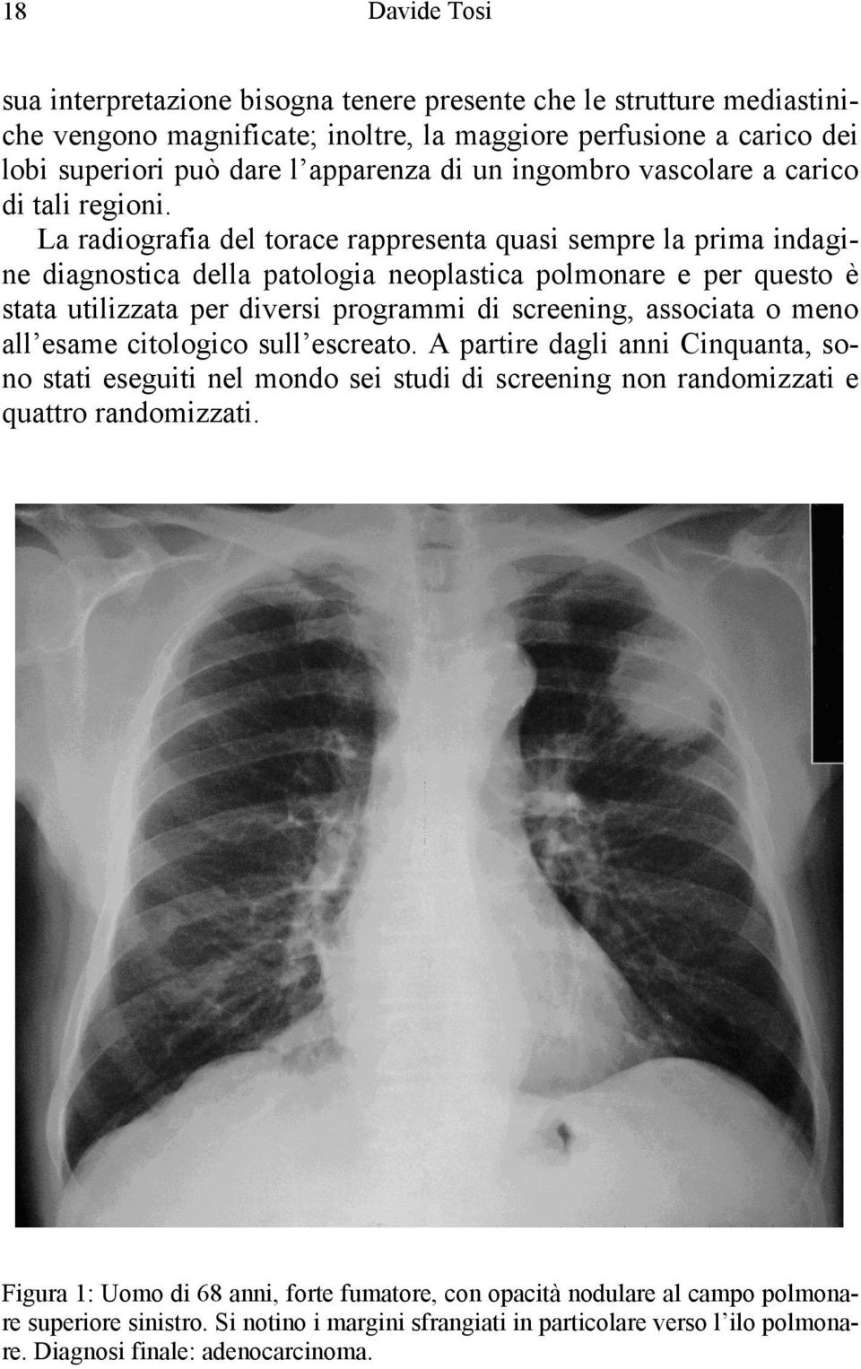 La radiografia del torace rappresenta quasi sempre la prima indagine diagnostica della patologia neoplastica polmonare e per questo è stata utilizzata per diversi programmi di screening, associata o