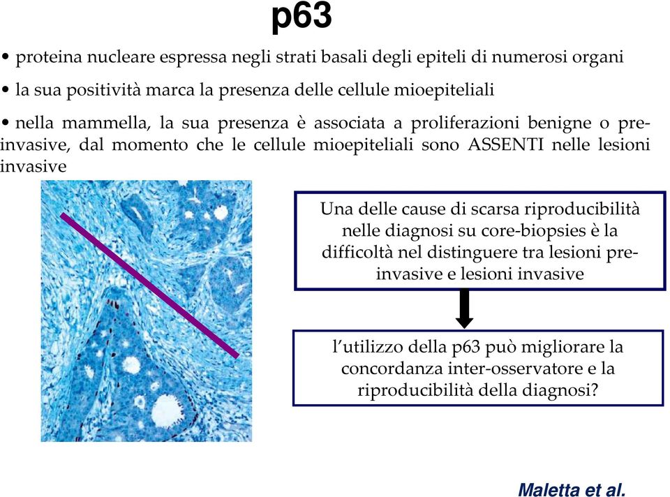 sono ASSENTI nelle lesioni invasive Una delle cause di scarsa riproducibilità nellediagnosisucore-biopsies èla difficoltà nel distinguere tra