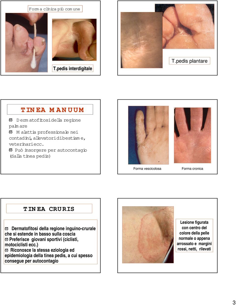 ϖ Può insorgere per autocontagio (dalla tineapedis) Forma vescicolosa Forma cronica TINEA CRURIS ϖ Dermatofitosi della regione inguino-crurale che si estende in