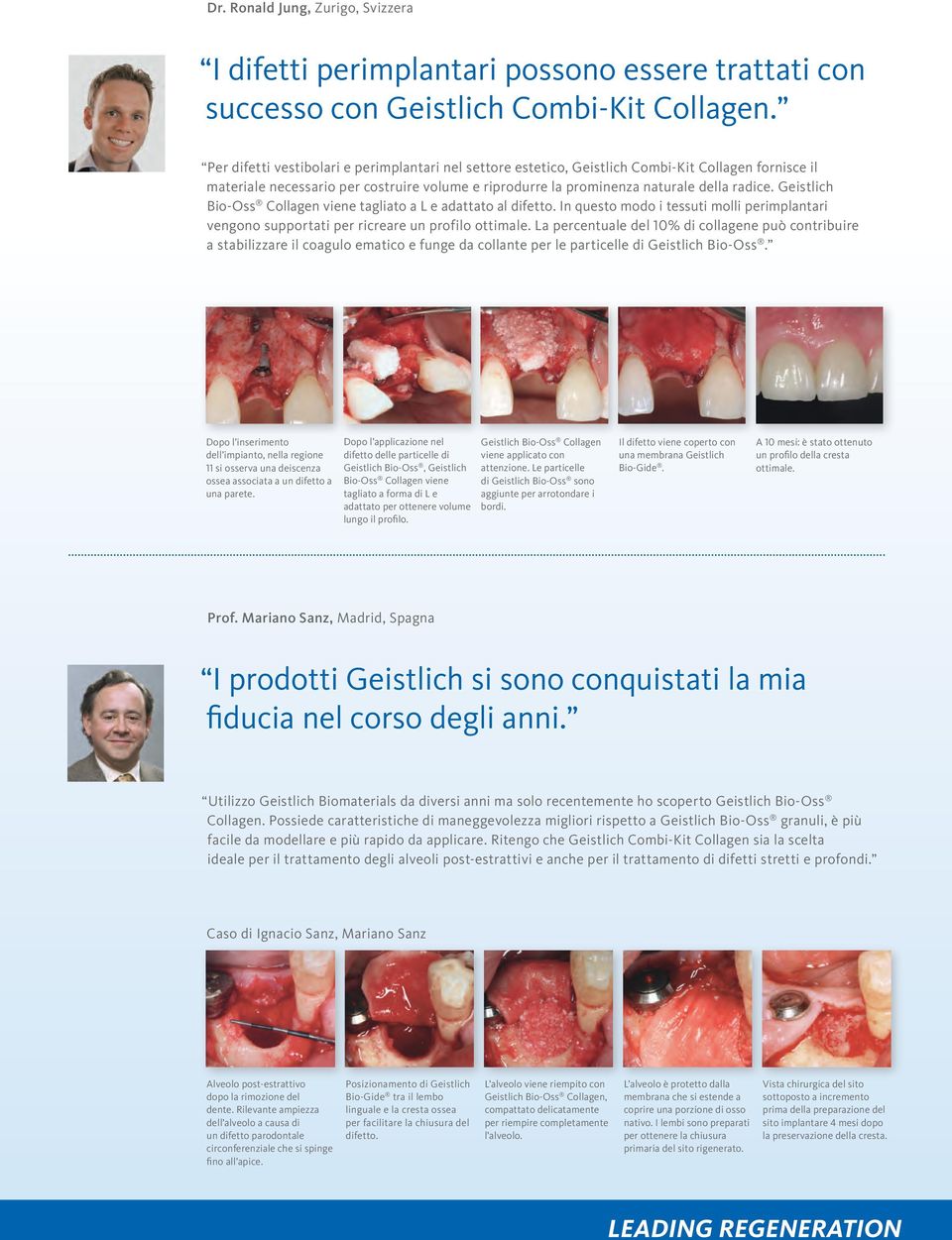 Geistlich Bio-Oss Collagen viene tagliato a L e adattato al difetto. In questo modo i tessuti molli perimplantari vengono supportati per ricreare un profilo ottimale.