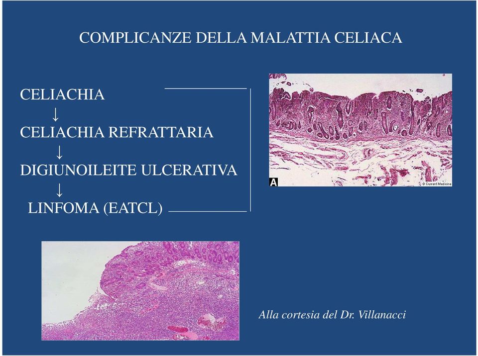 DIGIUNOILEITE ULCERATIVA LINFOMA