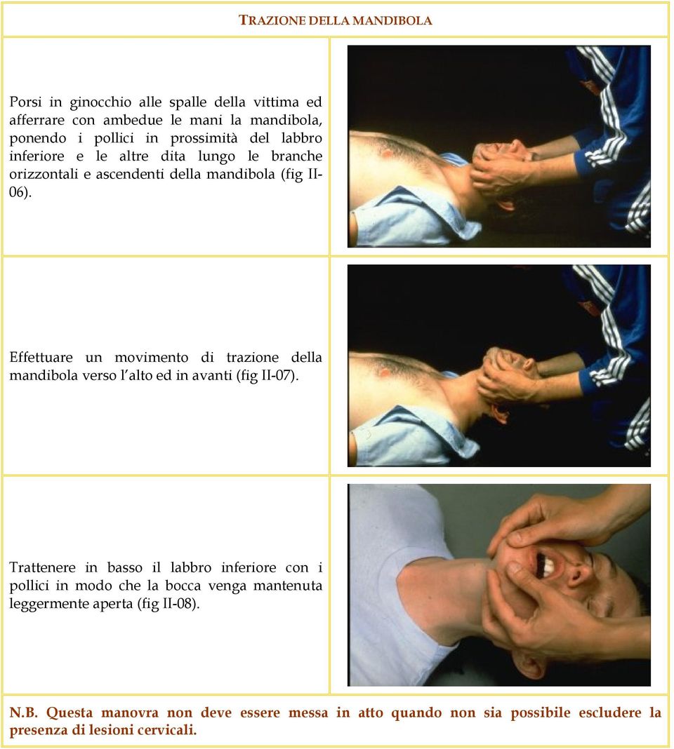 Effettuare un movimento di trazione della mandibola verso l alto ed in avanti (fig II-07).