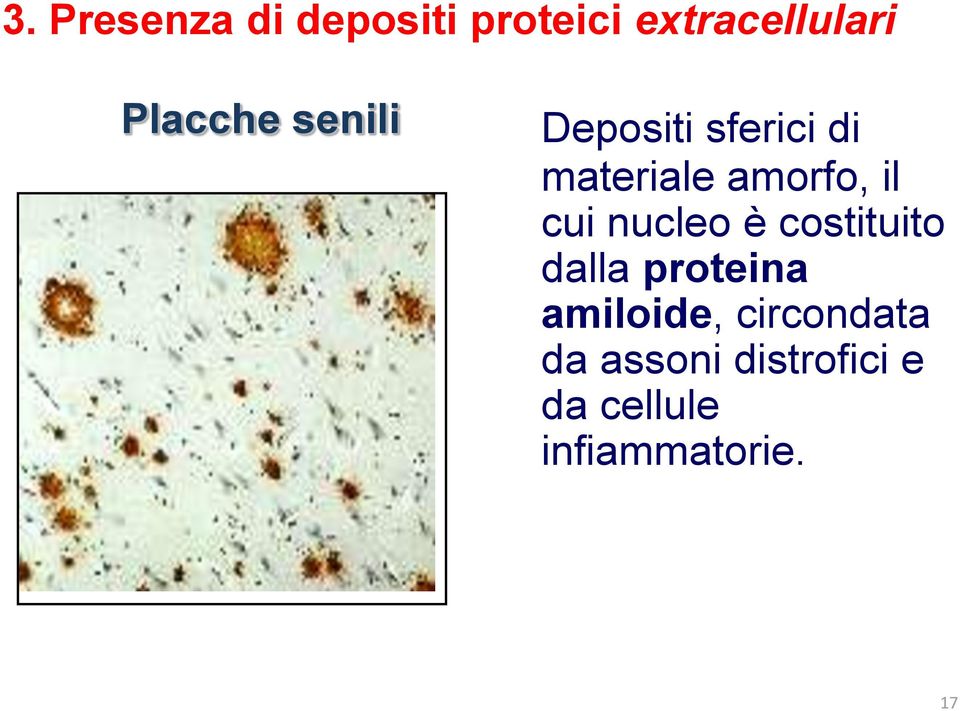 il cui nucleo è costituito dalla proteina amiloide,