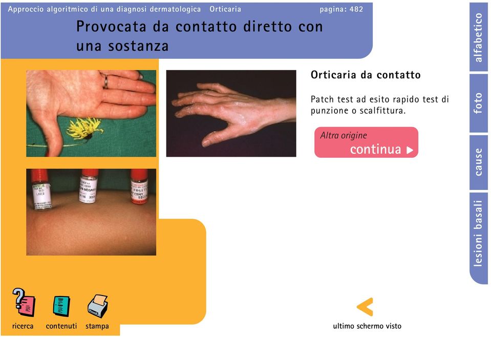 con una sostanza Orticaria da contatto Patch test ad