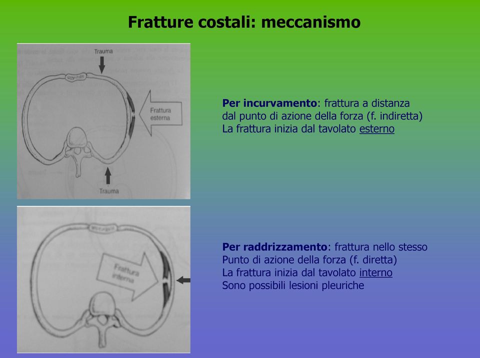 indiretta) La frattura inizia dal tavolato esterno Per raddrizzamento: