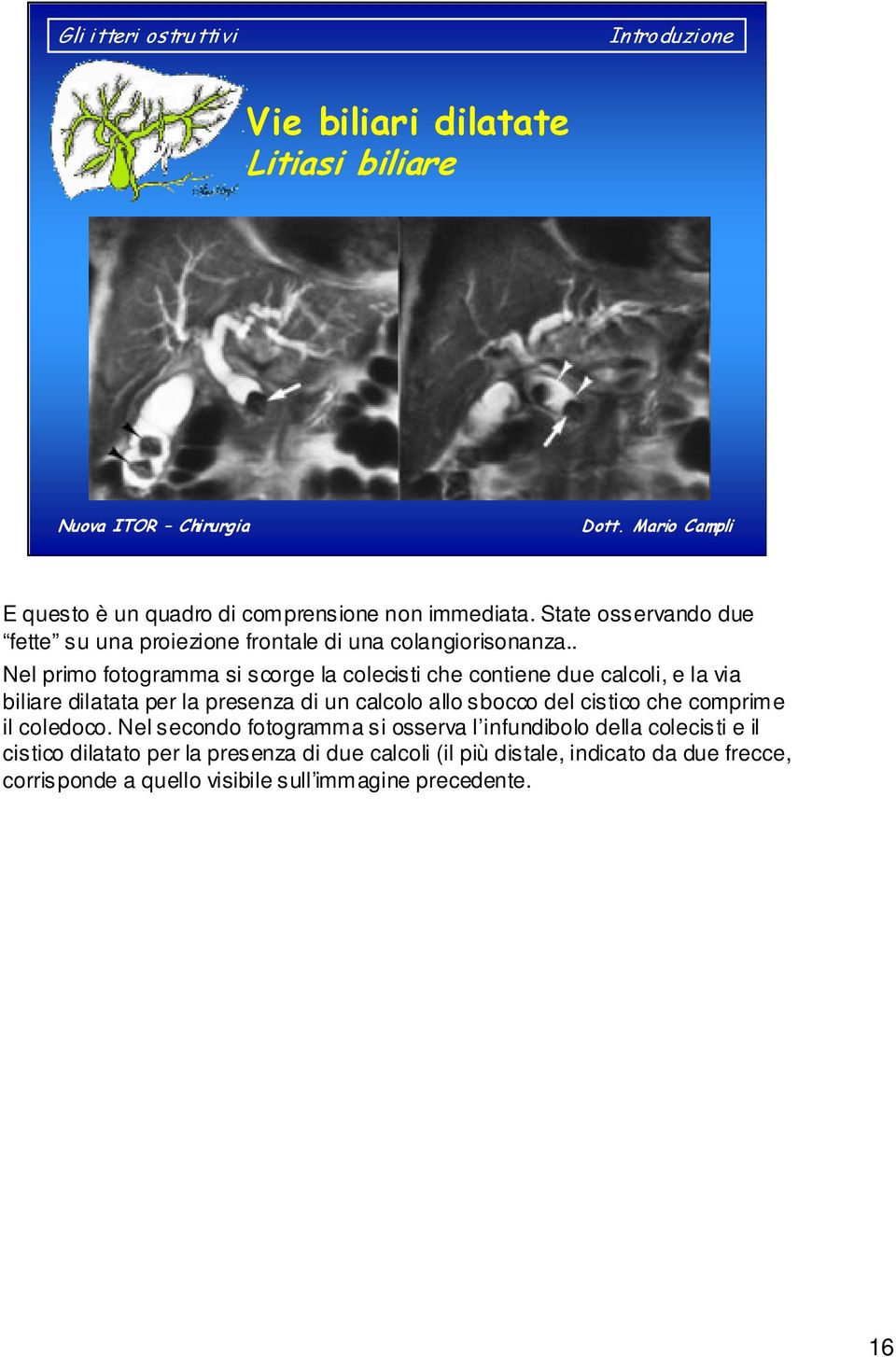 . Nel primo fotogramma si scorge la colecisti che contiene due calcoli, e la via biliare dilatata per la presenza di un calcolo allo