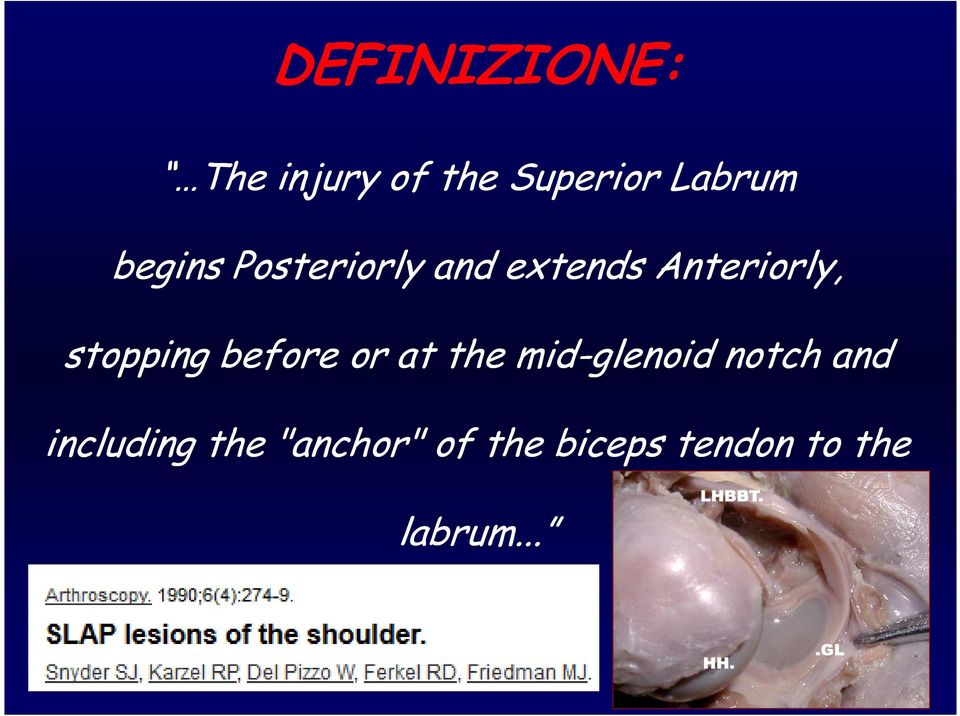 stopping before or at the mid-glenoid notch and