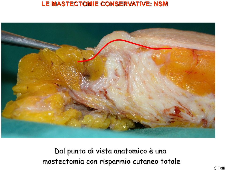 anatomico è una mastectomia