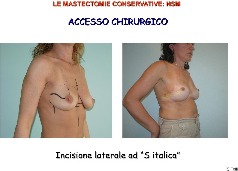 ACCESSO CHIRURGICO