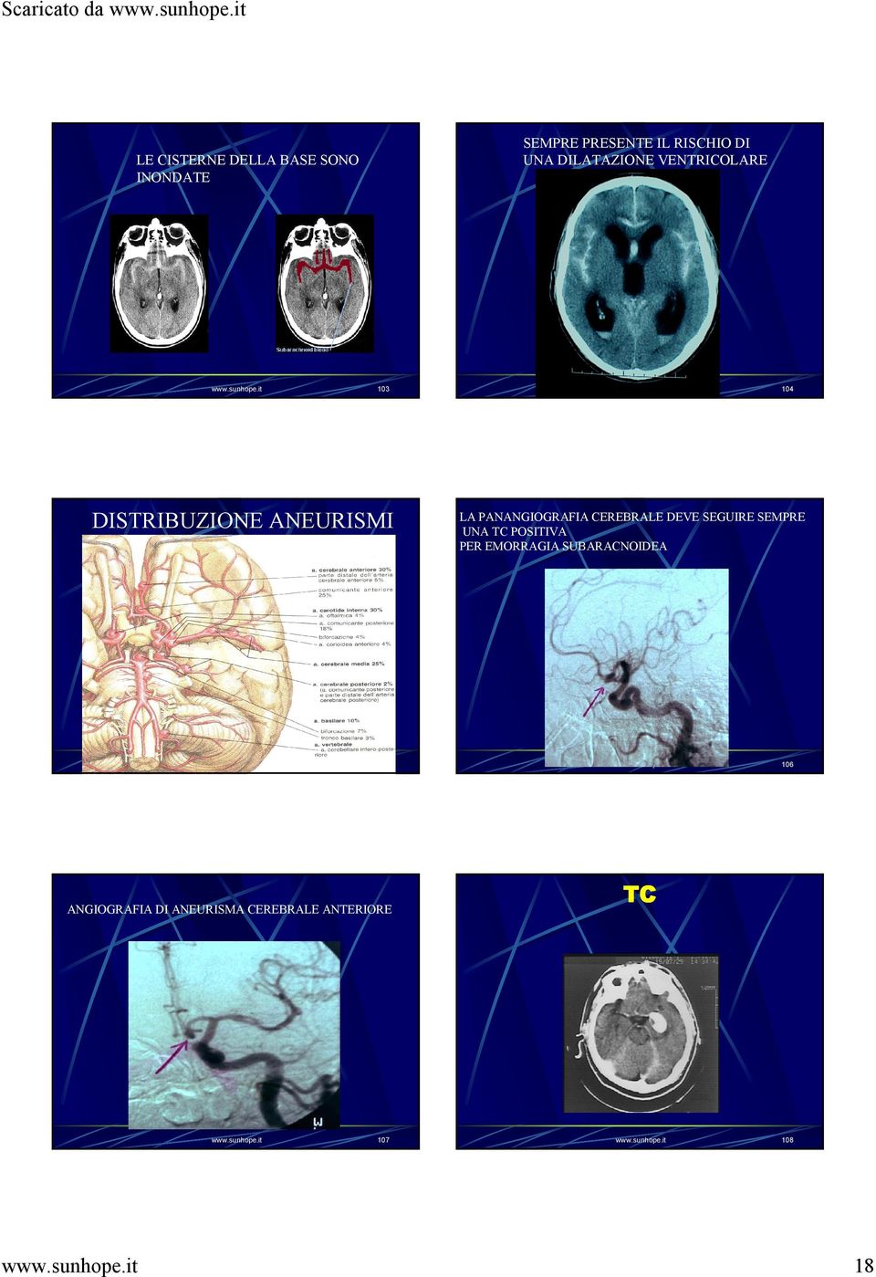 sunhope.it 103 DISTRIBUZIONE ANEURISMI www.sunhope.it 105 ANGIOGRAFIA DI ANEURISMA CEREBRALE ANTERIORE www.