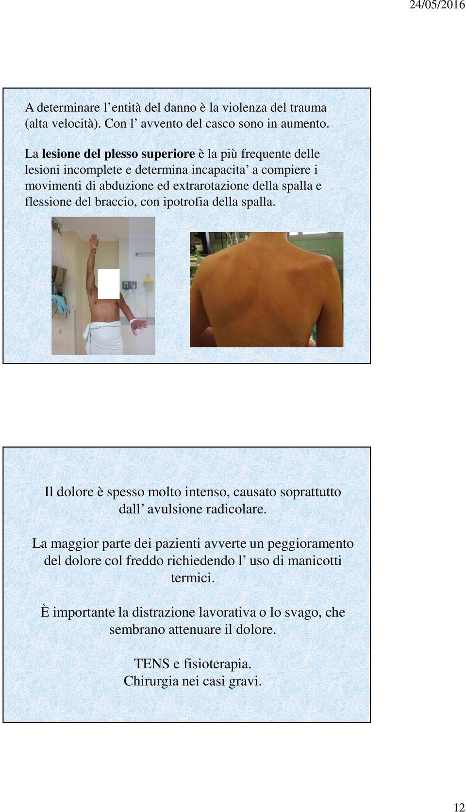 e flessione del braccio, con ipotrofia della spalla. Il dolore è spesso molto intenso, causato soprattutto dall avulsione radicolare.