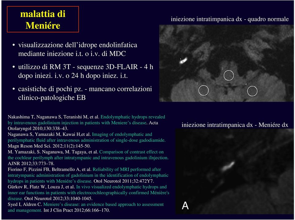 Endolymphatic hydrops revealed by intravenous gadolinium injection in patients with Meniere s disease. Acta Otolaryngol 2010;130:338 43. Naganawa S, Yamazaki M, Kawai H,et al.