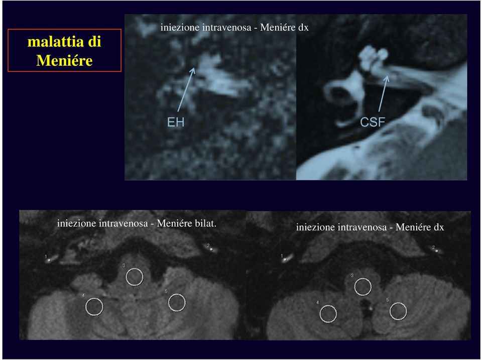 iniezione intravenosa - Meniére