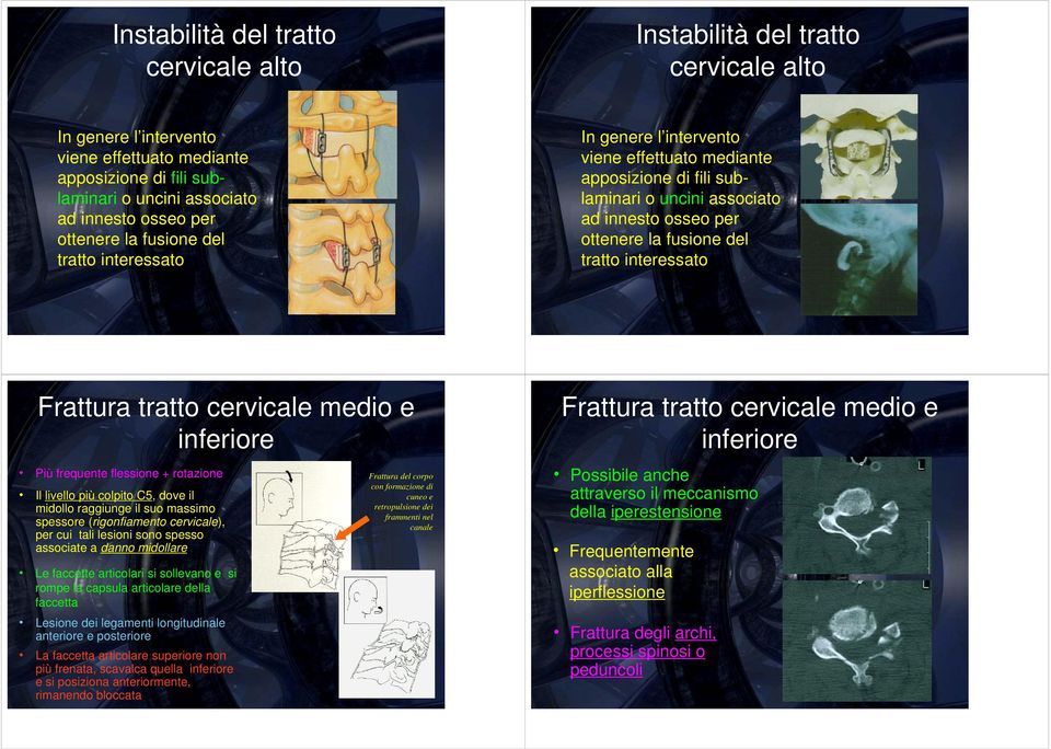 interessato Frattura tratto cervicale medio e inferiore Frattura tratto cervicale medio e inferiore Più frequente flessione + rotazione Il livello più colpito C5, dove il midollo raggiunge il suo