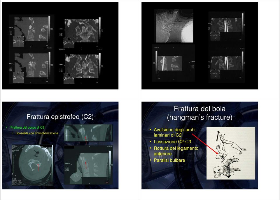 (hangman s fracture) Avulsione degli archi laminari di