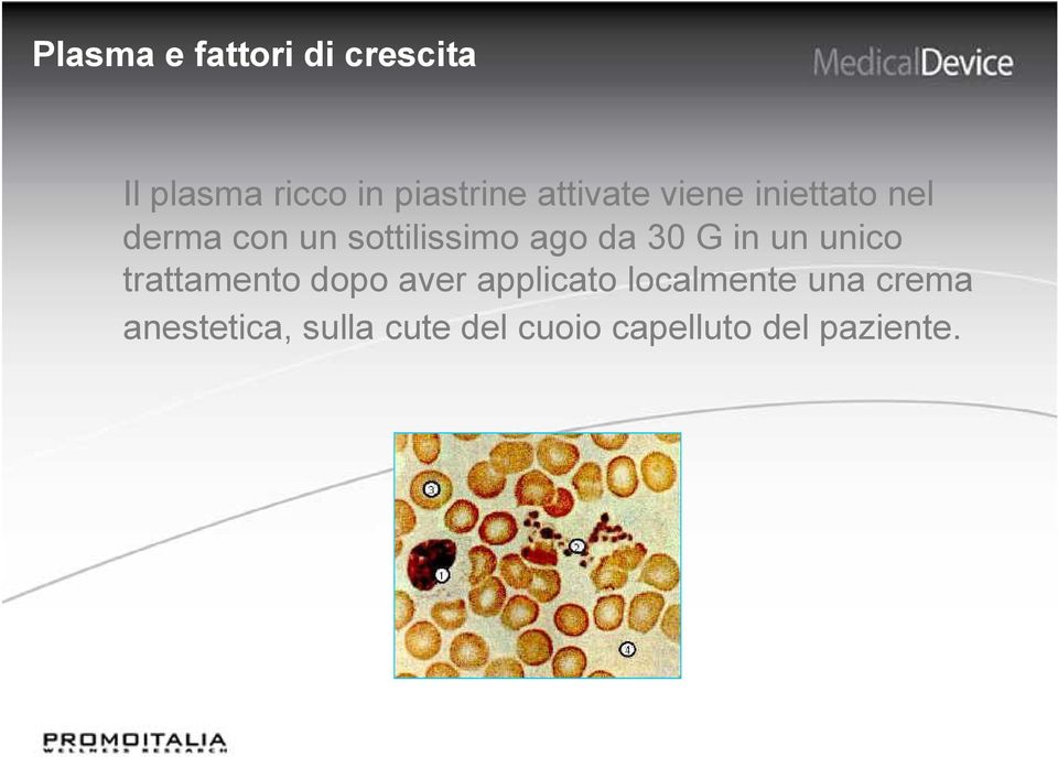 30 G in un unico trattamento dopo aver applicato localmente