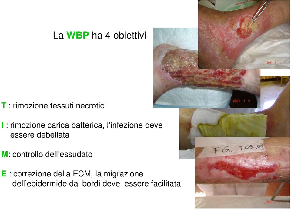 M: controllo dell essudato essudato E : correzione della ECM,