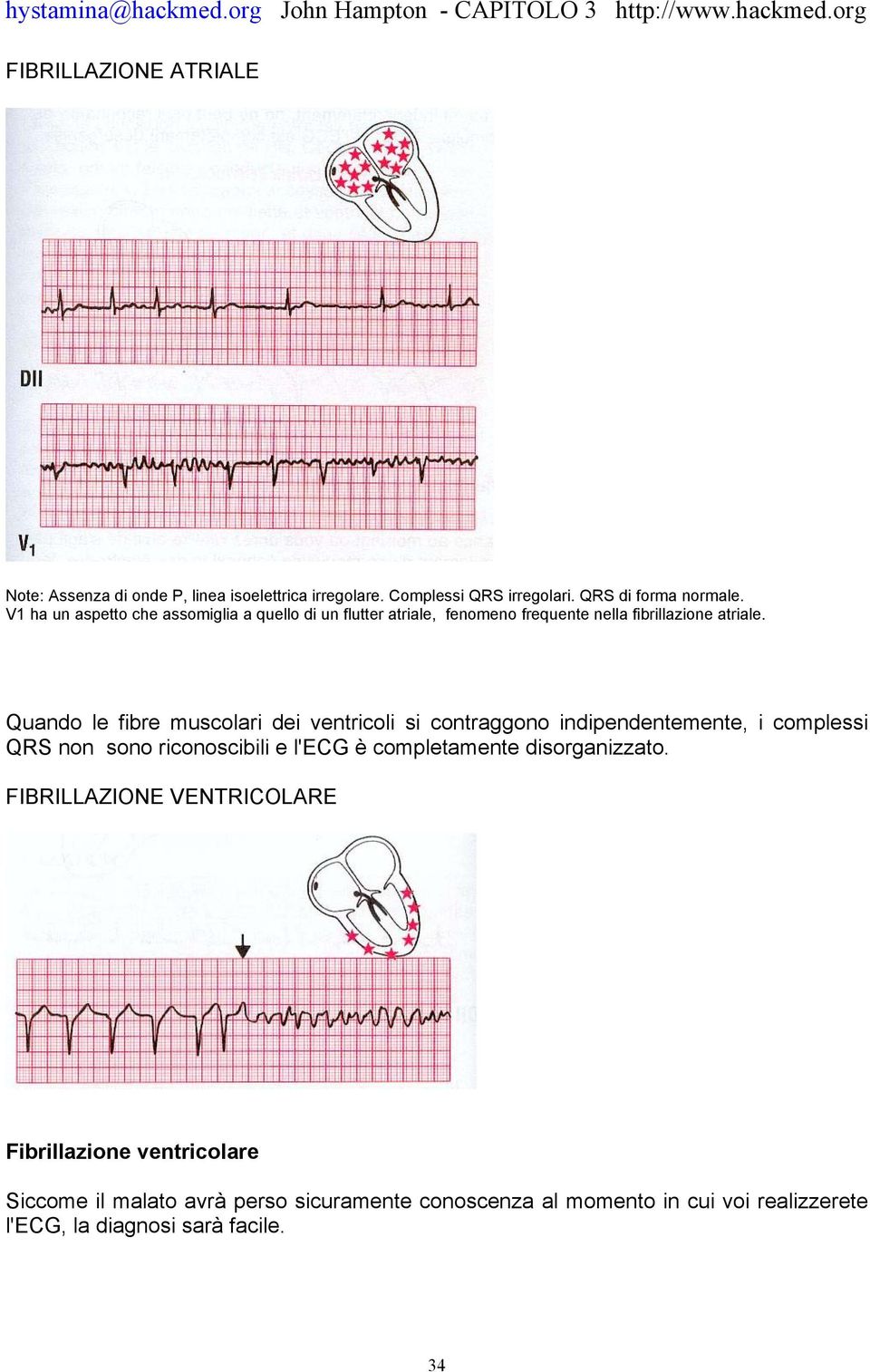 Quando le fibre muscolari dei ventricoli si contraggono indipendentemente, i complessi QRS non sono riconoscibili e l'ecg è completamente