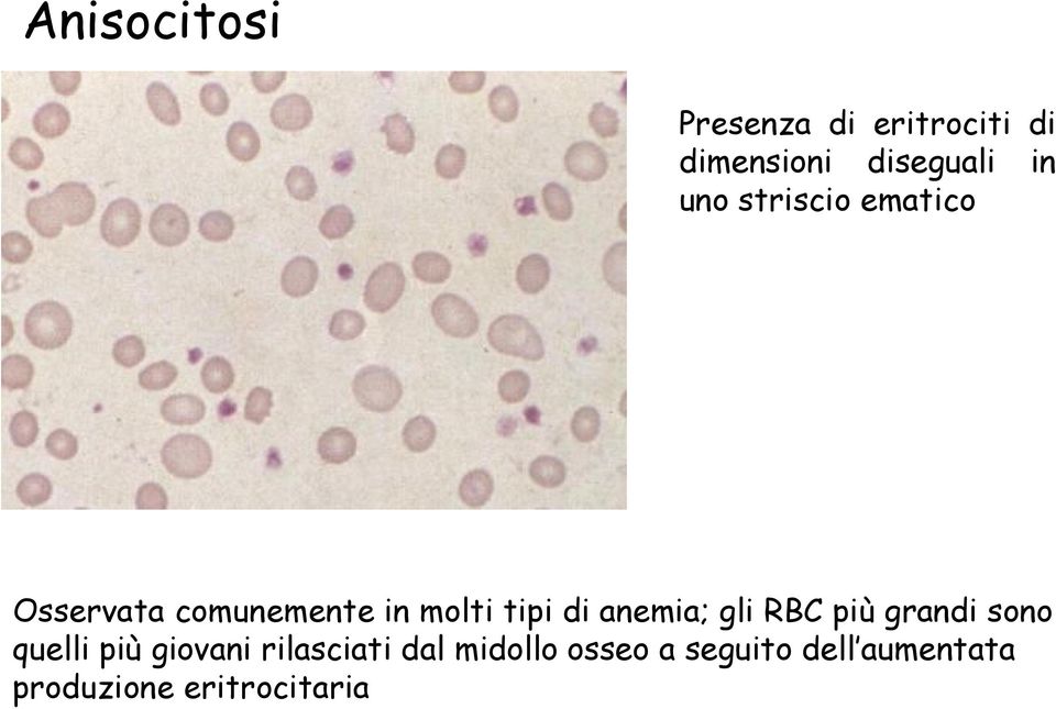 anemia; gli RBC più grandi sono quelli più giovani rilasciati