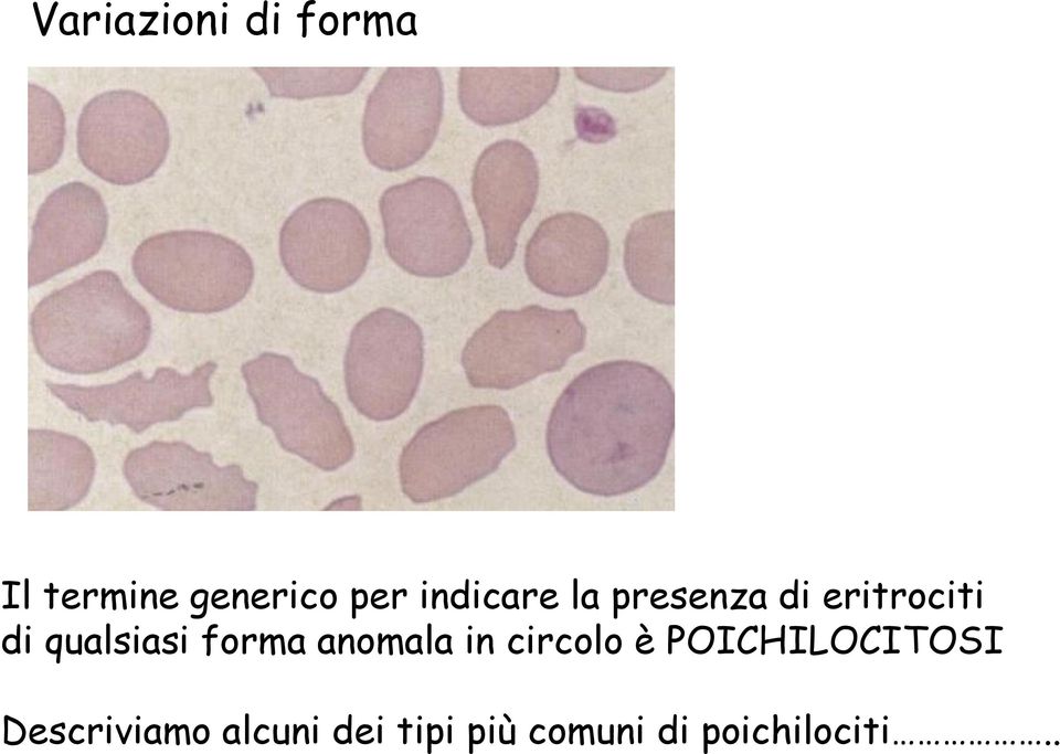 forma anomala in circolo è POICHILOCITOSI