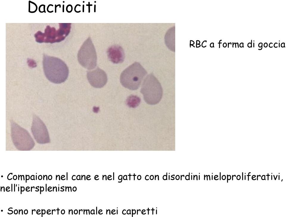 disordini mieloproliferativi, nell