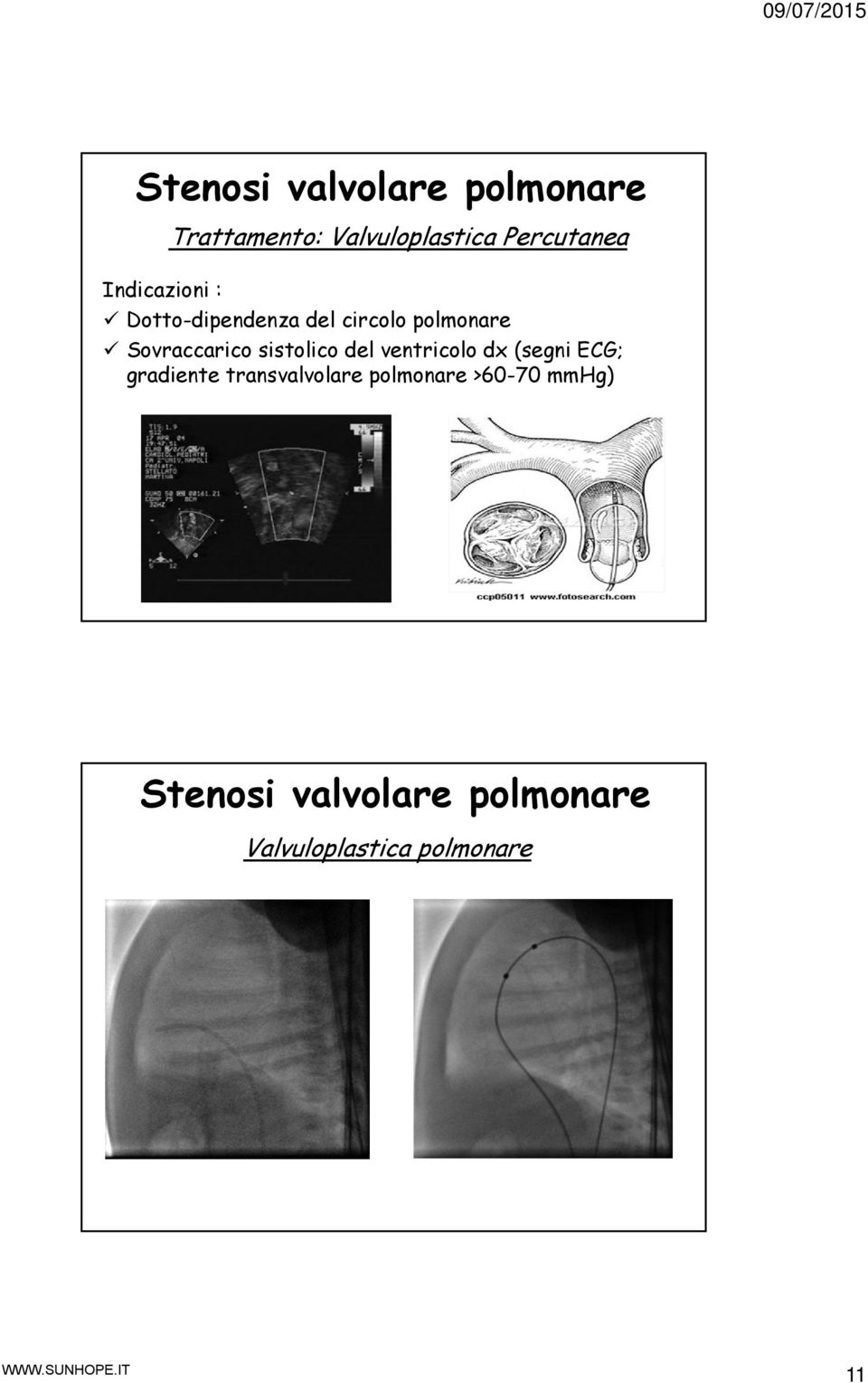 sistolico del ventricolo dx (segni ECG; gradiente