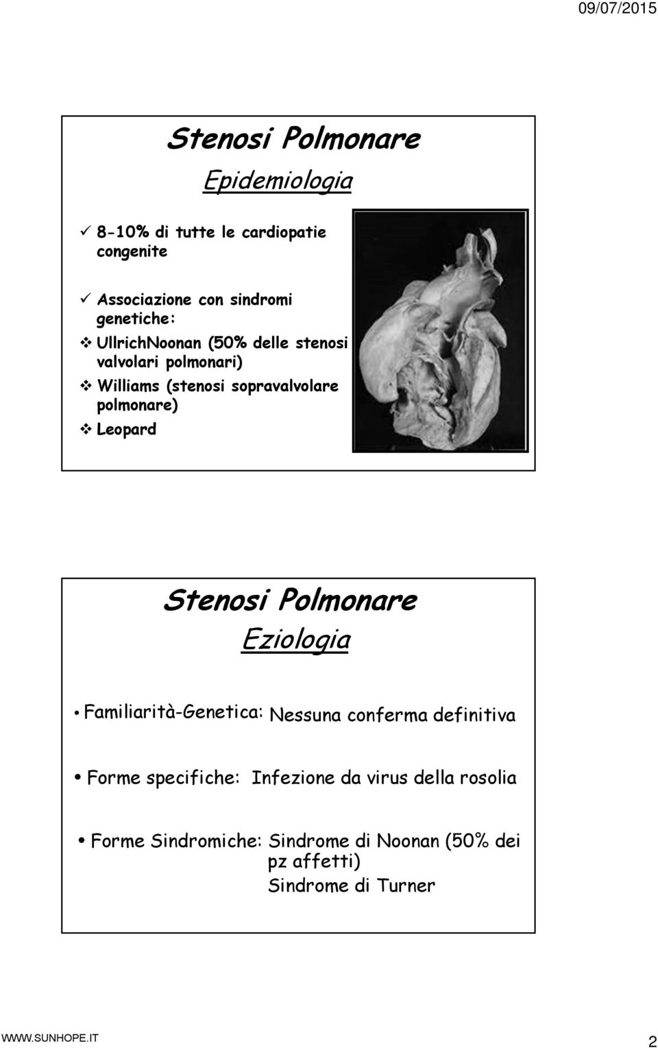 polmonare) Leopard Stenosi Polmonare Eziologia Familiarità-Genetica: Nessuna conferma definitiva Forme