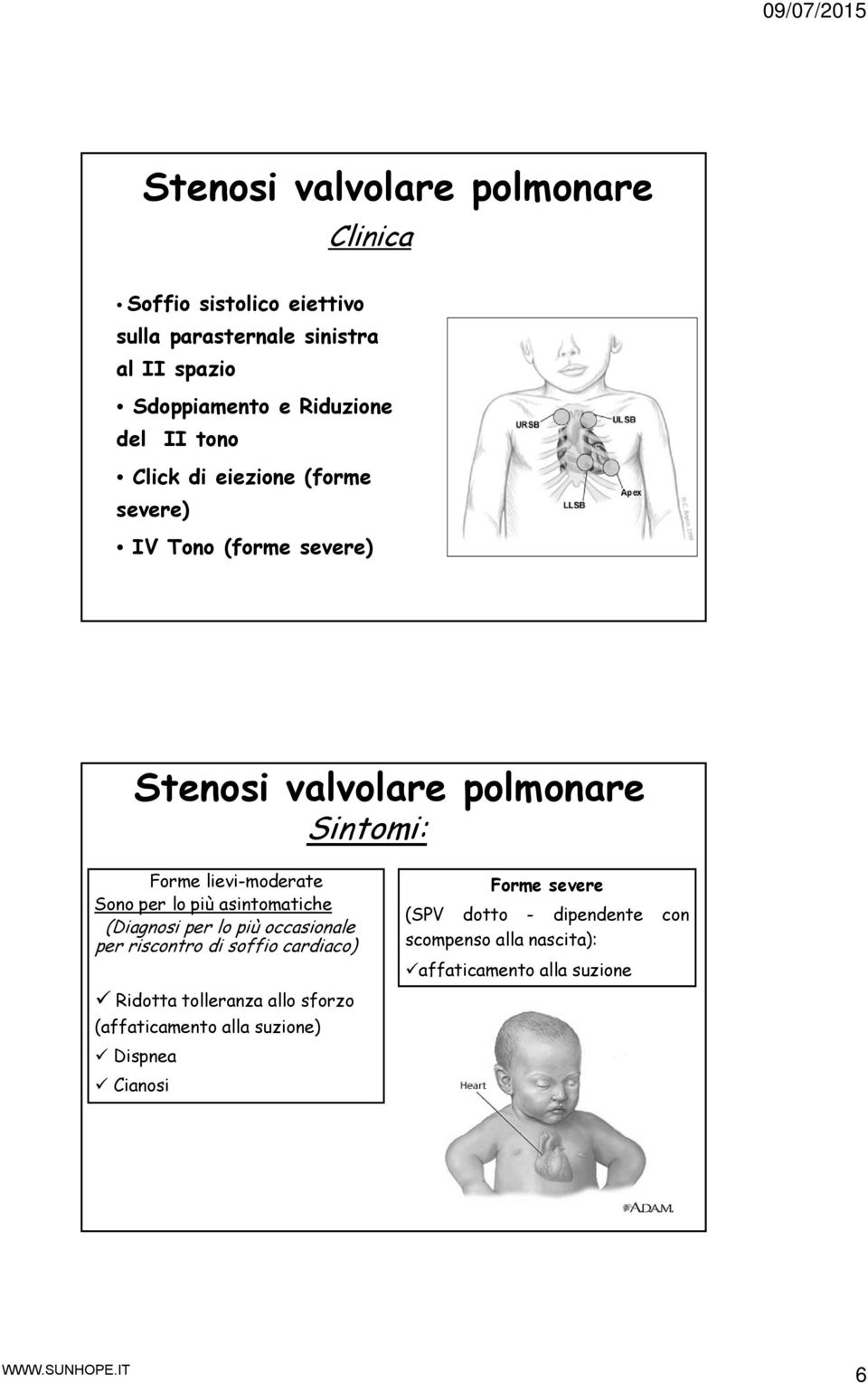 (Diagnosi per lo più occasionale per riscontro di soffio cardiaco) Forme severe (SPV dotto - dipendente con