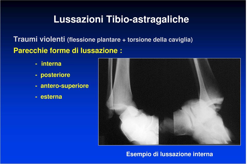 Parecchie forme di lussazione : - interna -