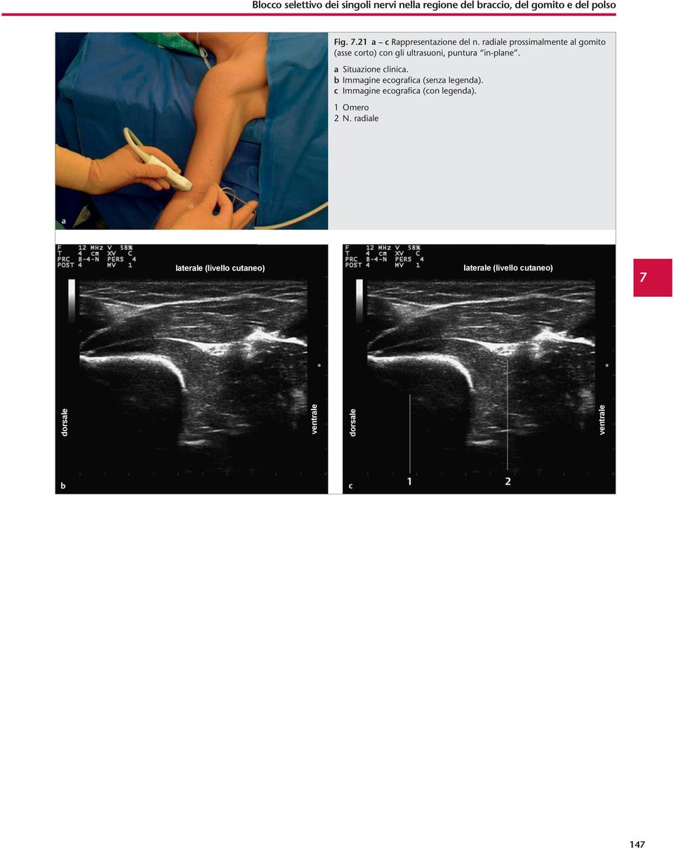 radiale prossimalmente al gomito (asse corto) con gli ultrasuoni, puntura in-plane. a Situazione clinica.