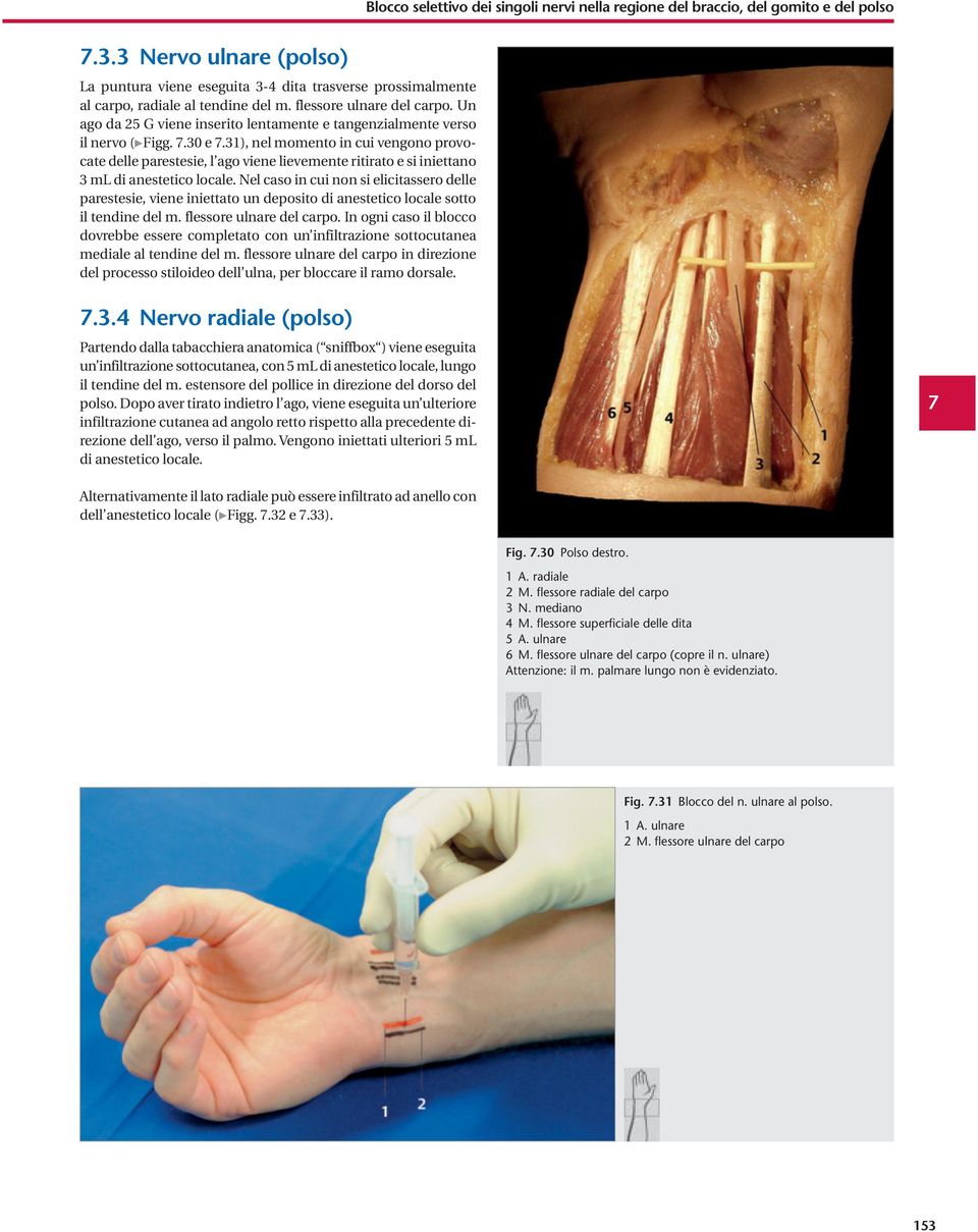 Un ago da 25 G viene inserito lentamente e tangenzialmente verso il nervo ( Figg. 7.30 e 7.