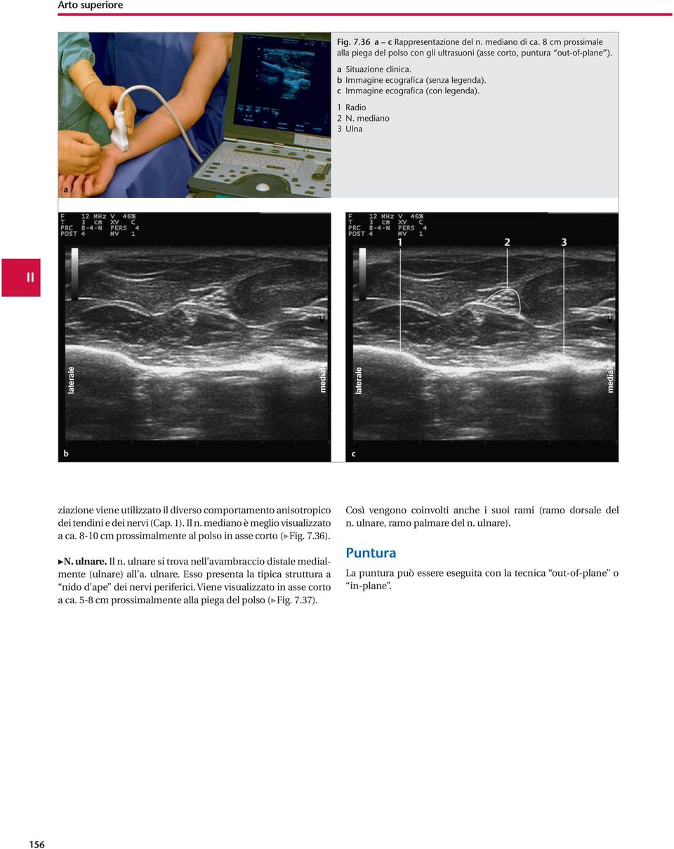 mediano 3 Ulna II laterale mediale laterale mediale ziazione viene utilizzato il diverso comportamento anisotropico dei tendini e dei nervi (Cap. 1). Il n. mediano è meglio visualizzato a ca.