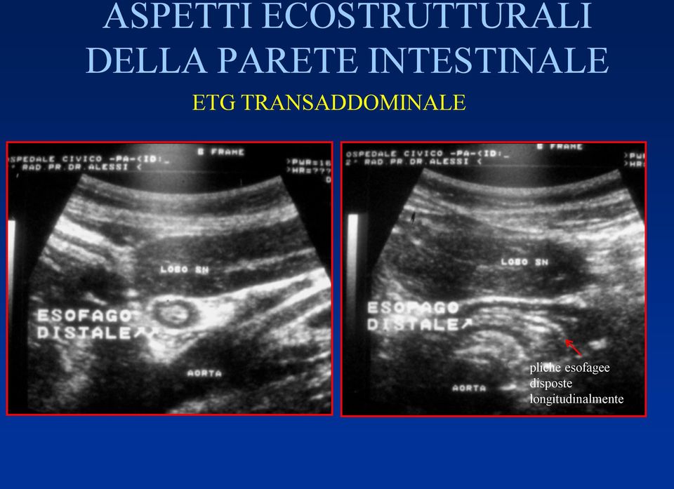 ETG TRANSADDOMINALE pliche