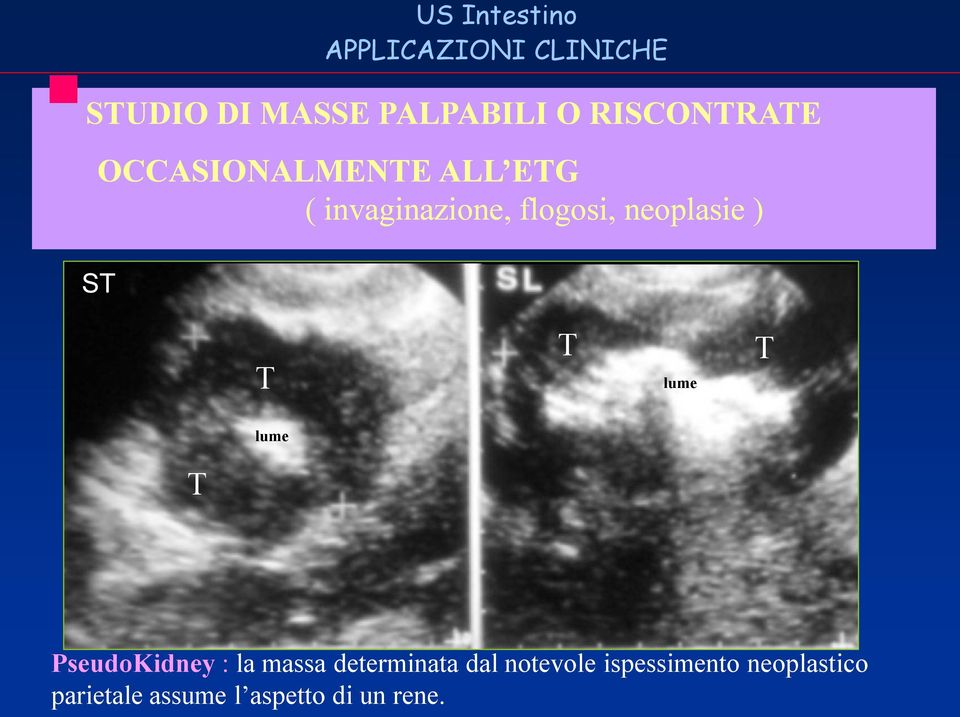 neoplasie ) ST T T lume T lume T PseudoKidney : la massa